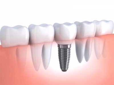 Capacitación en Odontología e Implantes